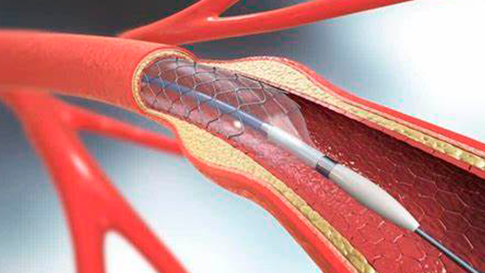 Después del Stent: ¿Cómo saber quién tiene más riesgo de sangrado? | Grupo i2